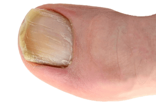 Engelska länkar om nagelsvamp och fotsvamp